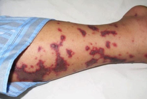 Cảnh báo bệnh viêm màng não do não mô cầu